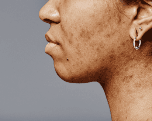 Pigmentation Treatment