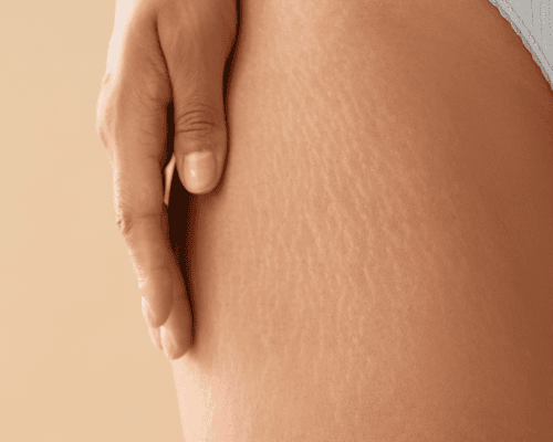 Stretch Mark Treatment