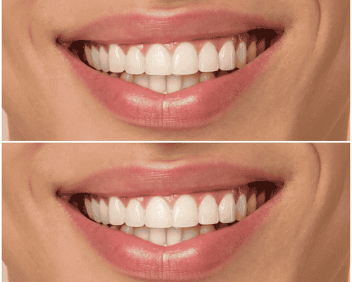 Teeth Whitening