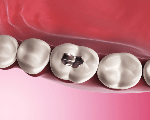 Tooth Fillings